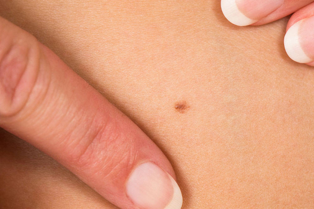 Symptoms and Causes of Skin Cancer