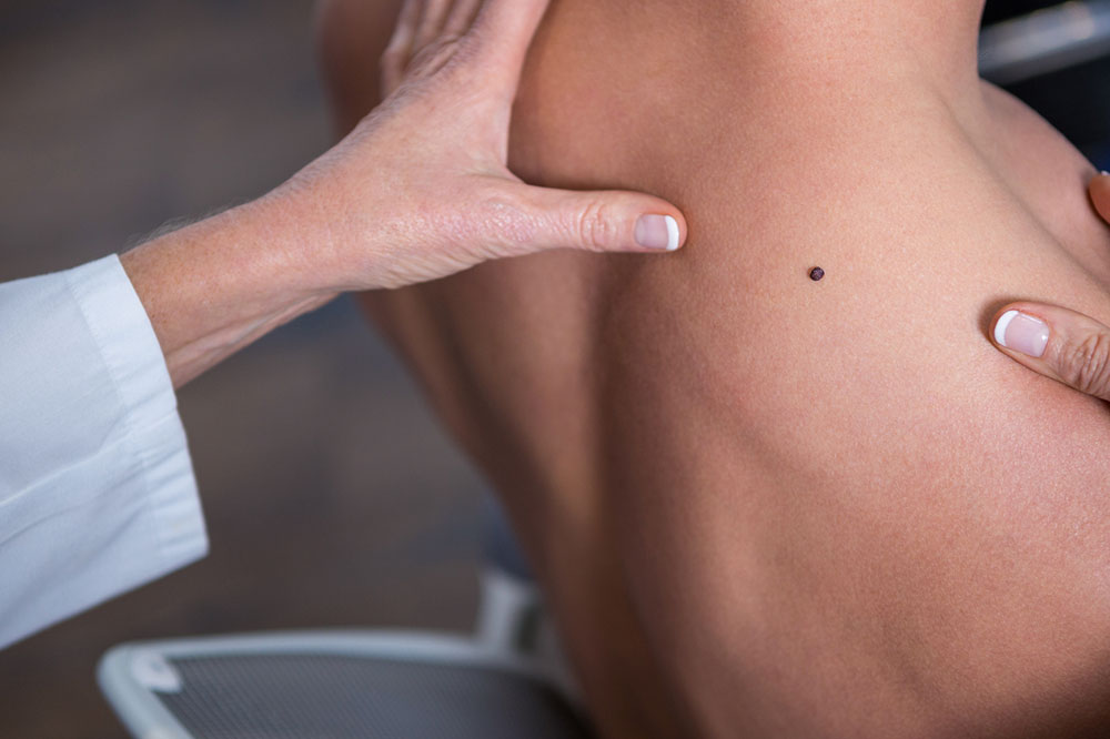 4 Effective Prevention Tips for Melanoma